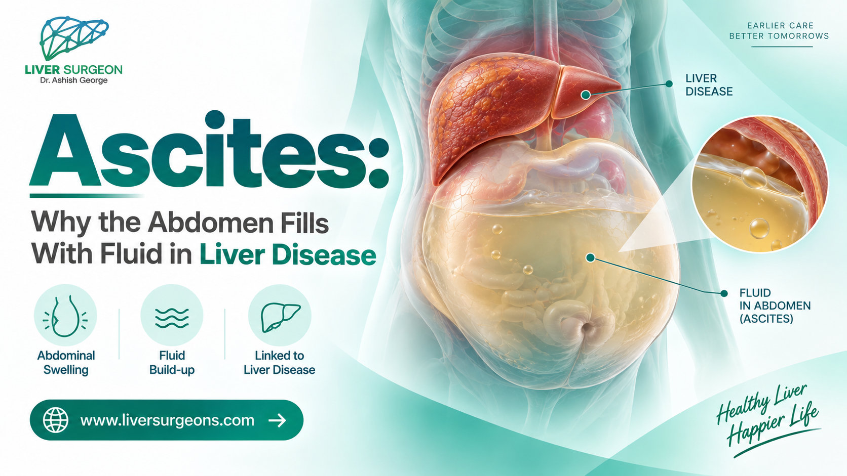 Ascites: Why the Abdomen Fills With Fluid in Liver Disease